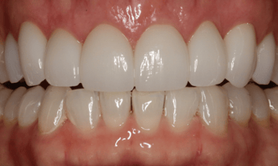After treatment - Anterior Crown's