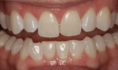 Before treatment - Anterior Crown's